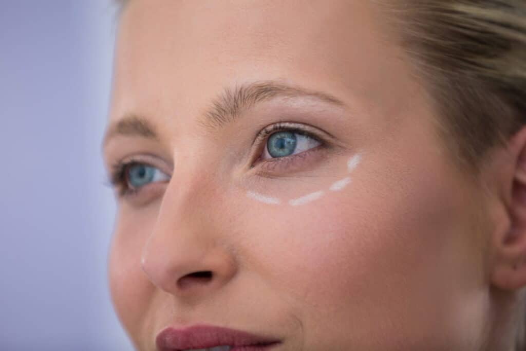 Mujer con marcas dibujadas para tratamientos cosméticos